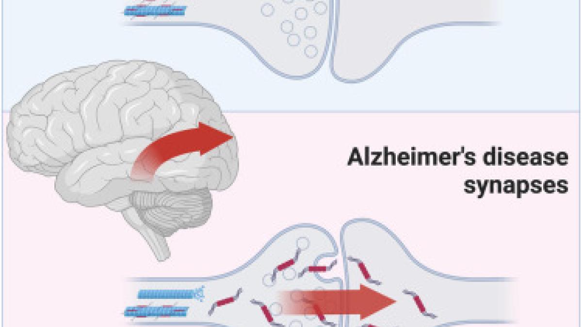 Alzheimer's diagram 